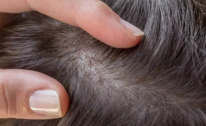 Chân Tóc Có Hạt Trắng: Nguyên Nhân, Dấu Hiệu Và Cách Khắc Phục Toàn Diện Chân Tóc Có Hạt Trắng: Nguyên Nhân, Dấu Hiệu Và Cách Khắc Phục Toàn Diện