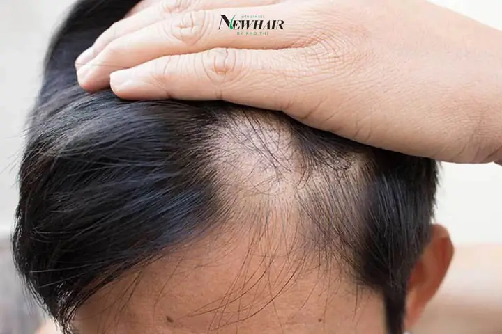 Chân Tóc Yếu Dễ Rụng: Nguyên Nhân, Dấu Hiệu Và Cách Phục Hồi Hiệu Quả
