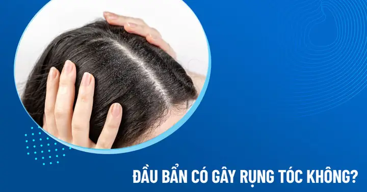 "rụng Tóc Không Ai Muốn": Nguyên Nhân, Cách Khắc Phục Hiệu Quả Và Phòng Ngừa "rụng Tóc Không Ai Muốn": Nguyên Nhân, Cách Khắc Phục Hiệu Quả Và Phòng Ngừa