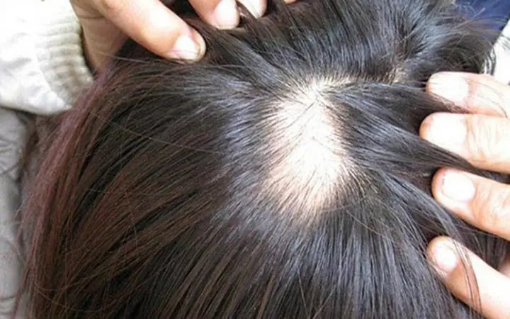 Chữa Rụng Tóc Nam Giới: Nguyên Nhân, Cách Điều Trị Hiệu Quả Và Ngăn Ngừa Hói Đầu Chữa Rụng Tóc Nam Giới: Nguyên Nhân, Cách Điều Trị Hiệu Quả Và Ngăn Ngừa Hói Đầu