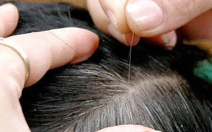 Có Nên Nhổ Tóc Xoăn Ngứa Không? Bác Sĩ Giải Đáp Tác Hại Và Cách Xử Lý Đúng Có Nên Nhổ Tóc Xoăn Ngứa Không? Bác Sĩ Giải Đáp Tác Hại Và Cách Xử Lý Đúng
