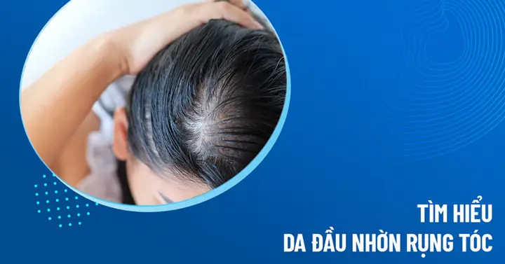 Da Đầu Nhờn Rụng Tóc: Nguyên Nhân, Cách Khắc Phục Và Phòng Ngừa Hiệu Quả