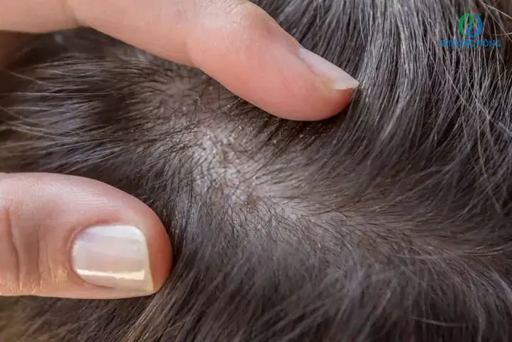 Đau Da Đầu Chân Tóc: Nguyên Nhân, Cách Xử Lý Và Lời Khuyên Từ Chuyên Gia Đau Da Đầu Chân Tóc: Nguyên Nhân, Cách Xử Lý Và Lời Khuyên Từ Chuyên Gia