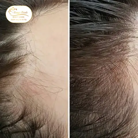 Điêu Khắc Chân Tóc: Giải Đáp "có Tốt Không" & Toàn Diện Lợi Ích, Rủi Ro Điêu Khắc Chân Tóc: Giải Đáp "có Tốt Không" & Toàn Diện Lợi Ích, Rủi Ro