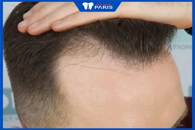 Đường Chân Tóc Chữ M: Ý Nghĩa, Kiểu Tóc Phù Hợp Và Cách Khắc Phục Hiệu Quả Đường Chân Tóc Chữ M: Ý Nghĩa, Kiểu Tóc Phù Hợp Và Cách Khắc Phục Hiệu Quả