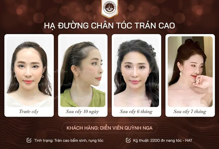 Giá Cấy Tóc Cho Người Trán Cao: Chi Phí, Yếu Tố Ảnh Hưởng & Kinh Nghiệm Giá Cấy Tóc Cho Người Trán Cao: Chi Phí, Yếu Tố Ảnh Hưởng & Kinh Nghiệm
