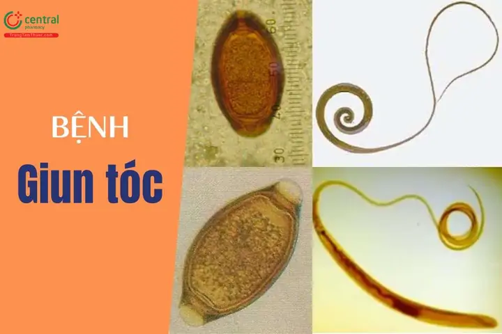 Giun Tóc (trichuris Trichiura): Tên Khoa Học, Đặc Điểm Và Tác Hại
