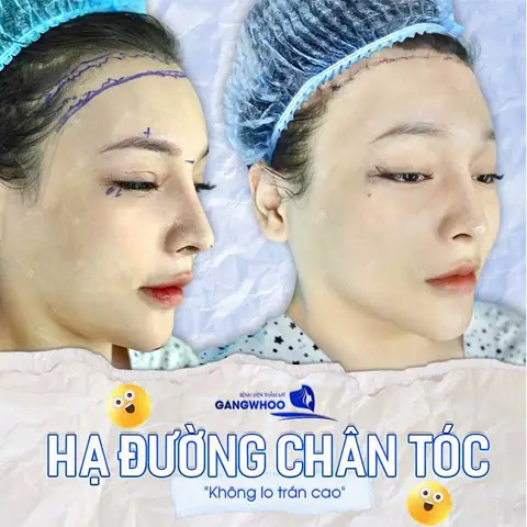 Phẫu Thuật Hạ Đường Chân Tóc: Có Nguy Hiểm Không? Giải Đáp A-z & Lưu Ý An Toàn