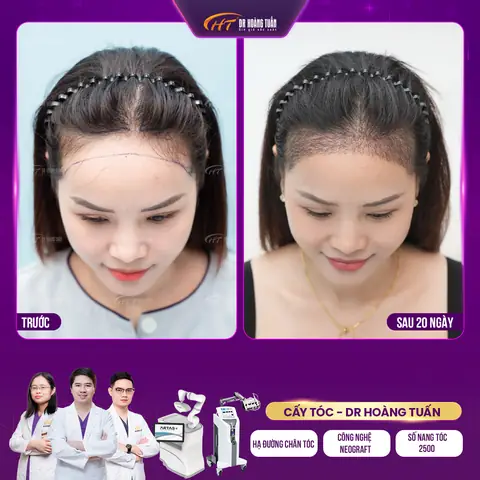 Chi Phí Hạ Đường Chân Tóc Bao Nhiêu? Bảng Giá Phẫu Thuật Chi Tiết 2026