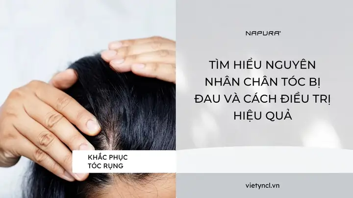 Hay Bị Đau Chân Tóc Là Bệnh Gì? Nguyên Nhân, Triệu Chứng Và Cách Điều Trị Hiệu Quả Tại Nhà Hay Bị Đau Chân Tóc Là Bệnh Gì? Nguyên Nhân, Triệu Chứng Và Cách Điều Trị Hiệu Quả Tại Nhà