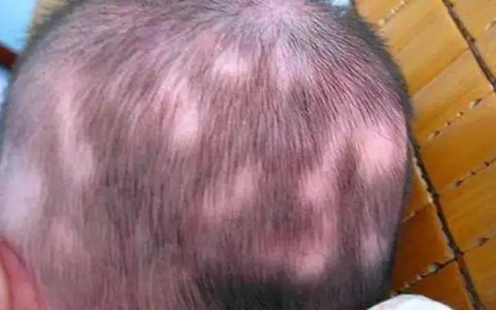 Rụng Tóc Máu Ở Trẻ Sơ Sinh: Hiện Tượng Bình Thường, Nguyên Nhân & Cách Xử Lý Đúng