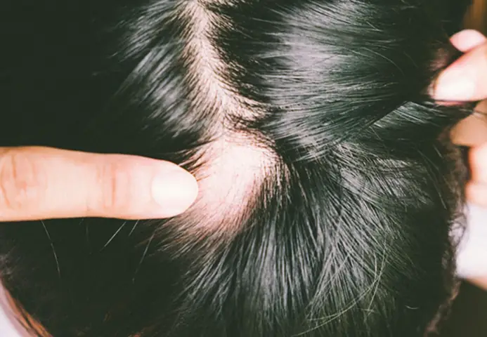 Rụng Tóc Từng Mảng: Nguyên Nhân, Hình Ảnh, Chẩn Đoán Và Cách Điều Trị Hiệu Quả Rụng Tóc Từng Mảng: Nguyên Nhân, Hình Ảnh, Chẩn Đoán Và Cách Điều Trị Hiệu Quả