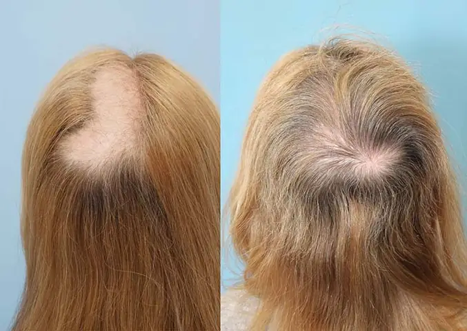 Hội Chứng Nghiện Nhổ Tóc (trichotillomania): Nguyên Nhân, Triệu Chứng, Ảnh Hưởng Và Cách Chữa Trị