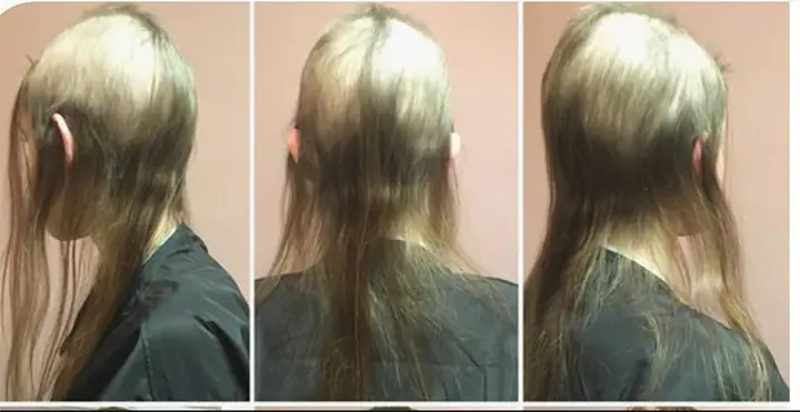 Hội Chứng Nghiện Nhổ Tóc (trichotillomania): Nguyên Nhân, Triệu Chứng, Ảnh Hưởng Và Cách Chữa Trị
