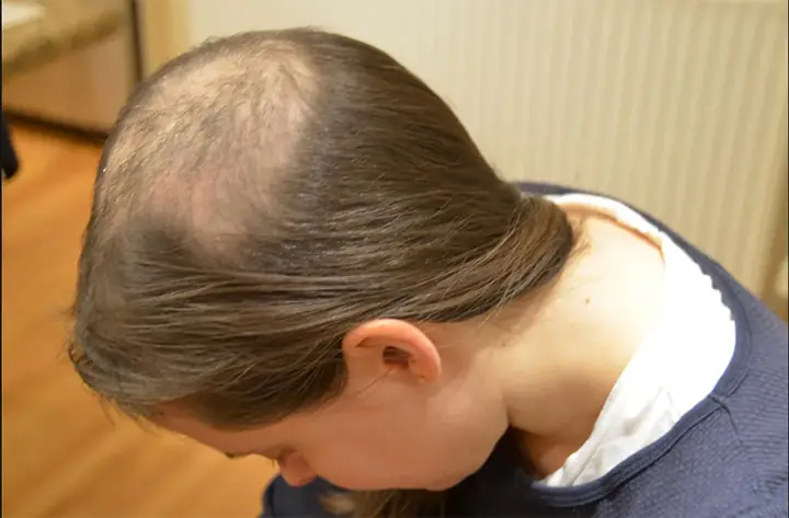 Hội Chứng Nghiện Nhổ Tóc (trichotillomania): Nguyên Nhân, Triệu Chứng, Ảnh Hưởng Và Cách Chữa Trị