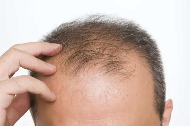 Làm Sao Để Kích Thích Mọc Tóc Ở Trán Nhanh Chóng Và Hiệu Quả? Làm Sao Để Kích Thích Mọc Tóc Ở Trán Nhanh Chóng Và Hiệu Quả?