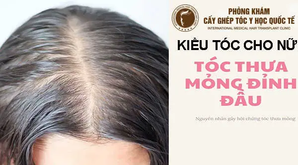 Top Kiểu Tóc Che Hói Đỉnh Đầu: Hướng Dẫn Chi Tiết Cho Nam & Nữ