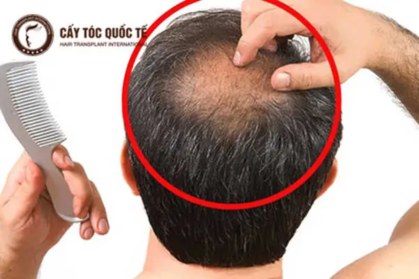Top Kiểu Tóc Che Hói Đỉnh Đầu: Hướng Dẫn Chi Tiết Cho Nam & Nữ