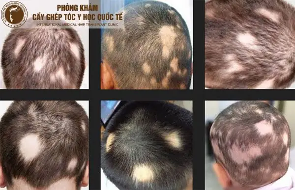 15+ Kinh Nghiệm Chữa Rụng Tóc Hiệu Quả Tại Nhà Mà Bạn Nên Biết