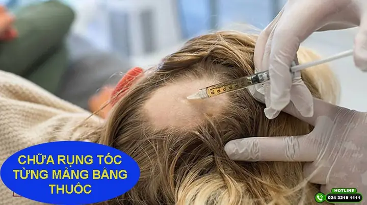 15+ Kinh Nghiệm Chữa Rụng Tóc Hiệu Quả Tại Nhà Mà Bạn Nên Biết