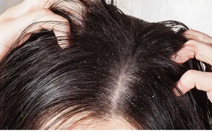 Bí Quyết Diệt Chấy Tận Gốc & An Toàn: Hướng Dẫn Chi Tiết Từ Chuyên Gia Bí Quyết Diệt Chấy Tận Gốc & An Toàn: Hướng Dẫn Chi Tiết Từ Chuyên Gia