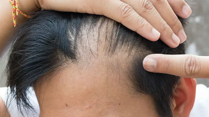 Tóc Con Mọc Lởm Chởm Trước Trán: Nguyên Nhân Và Cách Xử Lý Hiệu Quả Tóc Con Mọc Lởm Chởm Trước Trán: Nguyên Nhân Và Cách Xử Lý Hiệu Quả