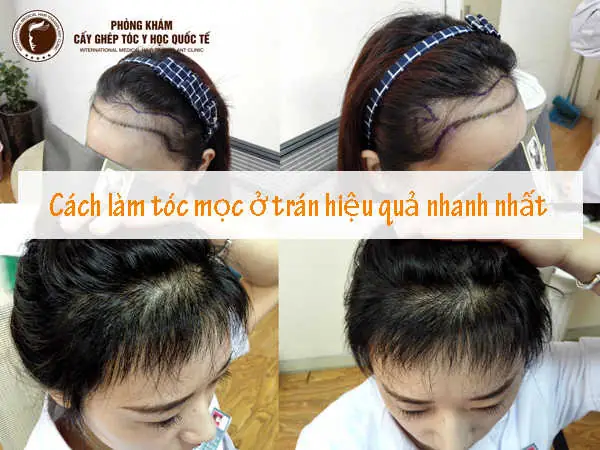 Tóc Con Mọc Lởm Chởm Trước Trán: Nguyên Nhân Và Cách Xử Lý Hiệu Quả Tóc Con Mọc Lởm Chởm Trước Trán: Nguyên Nhân Và Cách Xử Lý Hiệu Quả