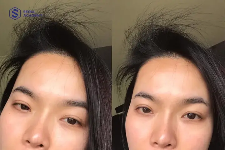 Tóc Con Mọc Lởm Chởm Trước Trán: Nguyên Nhân Và Cách Xử Lý Hiệu Quả Tóc Con Mọc Lởm Chởm Trước Trán: Nguyên Nhân Và Cách Xử Lý Hiệu Quả