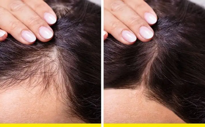 15+ Cách Kích Thích Mọc Tóc Nhanh, Hiệu Quả Tại Nhà Cho Nam & Nữ 15+ Cách Kích Thích Mọc Tóc Nhanh, Hiệu Quả Tại Nhà Cho Nam & Nữ