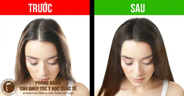 Bí Quyết Tóc Mọc Dày Nhanh Chóng: 15 Cách Tự Nhiên Và Hiệu Quả Tại Nhà Bí Quyết Tóc Mọc Dày Nhanh Chóng: 15 Cách Tự Nhiên Và Hiệu Quả Tại Nhà