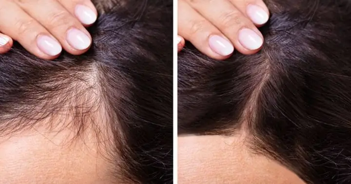 Bí Quyết Giúp Tóc Mọc Nhiều Và Dày Nhanh Chóng, Tự Nhiên Tại Nhà Bí Quyết Giúp Tóc Mọc Nhiều Và Dày Nhanh Chóng, Tự Nhiên Tại Nhà