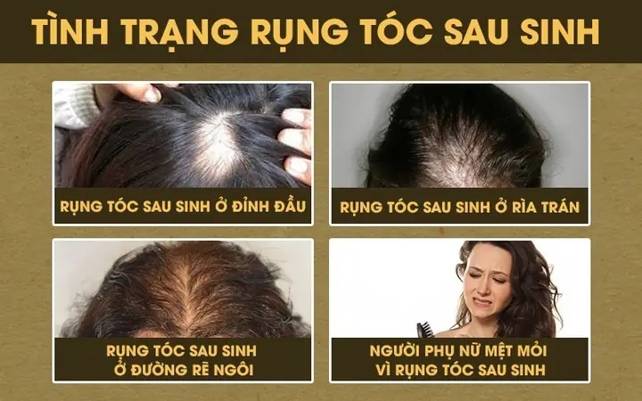 Mẹo Chữa Rụng Tóc Sau Sinh Hiệu Quả: Hướng Dẫn Chi Tiết Cho Mẹ Bỉm Sữa Lấy Lại Mái Tóc Dày Mượt