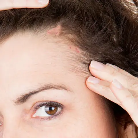 Mụn Mọc Ở Trán Gần Chân Tóc: Nguyên Nhân, Cách Khắc Phục & Phòng Tránh Hiệu Quả