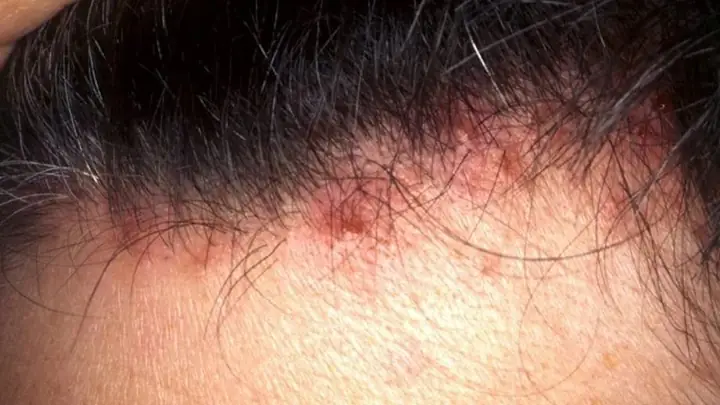 Mụn Mọc Ở Trán Gần Chân Tóc: Nguyên Nhân, Cách Khắc Phục & Phòng Tránh Hiệu Quả