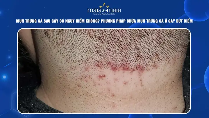 Mụn Mọc Sau Gáy: Nguyên Nhân, Dấu Hiệu Và Cách Điều Trị Hiệu Quả Mụn Mọc Sau Gáy: Nguyên Nhân, Dấu Hiệu Và Cách Điều Trị Hiệu Quả