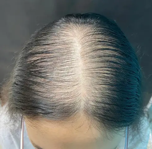 Rụng Tóc Hói Đầu: Nguyên Nhân Sâu Xa Và Giải Pháp Toàn Diện