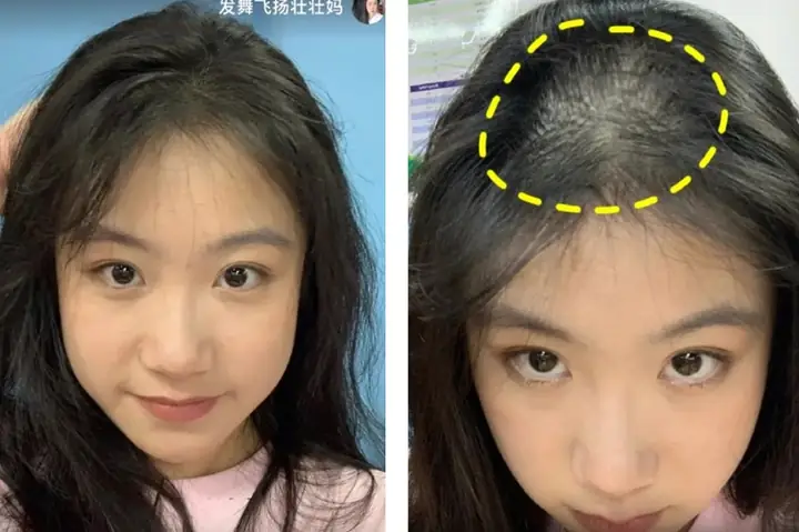 Rụng Tóc Hói Đầu: Nguyên Nhân Sâu Xa Và Giải Pháp Toàn Diện