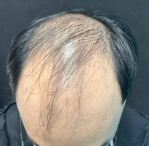 Rụng Tóc Hói Đầu: Nguyên Nhân Sâu Xa Và Giải Pháp Toàn Diện
