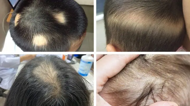 Nguyên Nhân Rụng Tóc Ở Trẻ 10 Tuổi: Dấu Hiệu, Cách Xử Lý Và Phòng Ngừa Hiệu Quả Nguyên Nhân Rụng Tóc Ở Trẻ 10 Tuổi: Dấu Hiệu, Cách Xử Lý Và Phòng Ngừa Hiệu Quả
