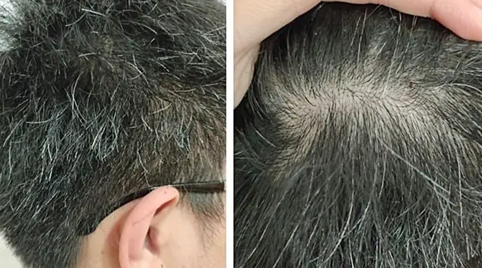 Nguyên Nhân Tóc Bạc Sớm Ở Người Trẻ: Hiểu Rõ & Ngăn Ngừa Hiệu Quả