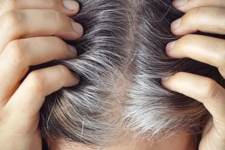 Tóc Bạc Sớm Ở Thanh Niên: Nguyên Nhân, Dấu Hiệu Và Cách Khắc Phục Hiệu Quả Tóc Bạc Sớm Ở Thanh Niên: Nguyên Nhân, Dấu Hiệu Và Cách Khắc Phục Hiệu Quả