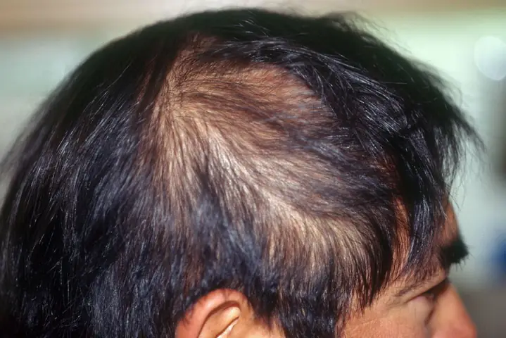 Nguyên Nhân Tóc Thưa Mỏng Và Cách Khắc Phục Hiệu Quả: Chuyên Gia Giải Đáp Từ A-z Nguyên Nhân Tóc Thưa Mỏng Và Cách Khắc Phục Hiệu Quả: Chuyên Gia Giải Đáp Từ A-z