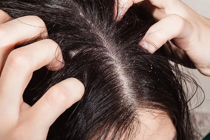 Nhuộm Tóc Bị Ngứa Da Đầu: Nguyên Nhân, Cách Xử Lý & Phòng Ngừa Hiệu Quả