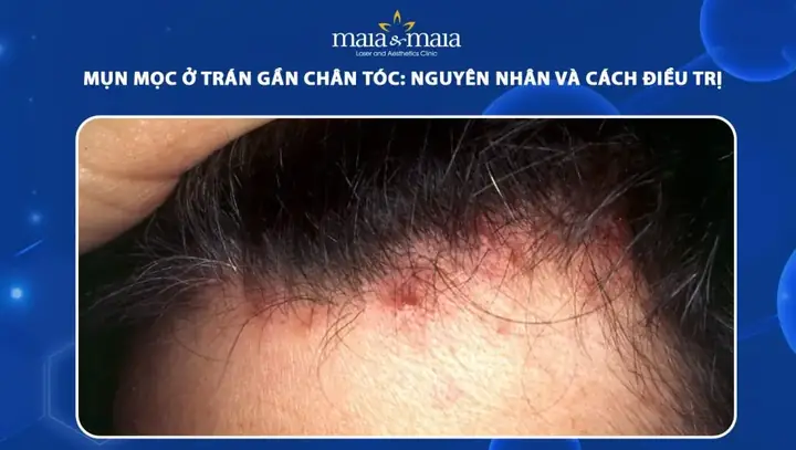 Mụn Ở Chân Tóc: Nguyên Nhân, Cách Nhận Biết Và Giải Pháp Điều Trị Hiệu Quả Mụn Ở Chân Tóc: Nguyên Nhân, Cách Nhận Biết Và Giải Pháp Điều Trị Hiệu Quả