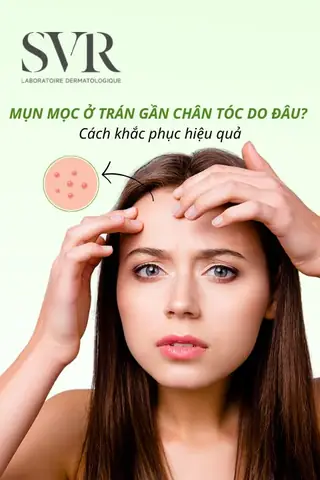 Mụn Nổi Gần Chân Tóc: Nguyên Nhân, Cách Điều Trị Và Phòng Ngừa Hiệu Quả Mụn Nổi Gần Chân Tóc: Nguyên Nhân, Cách Điều Trị Và Phòng Ngừa Hiệu Quả