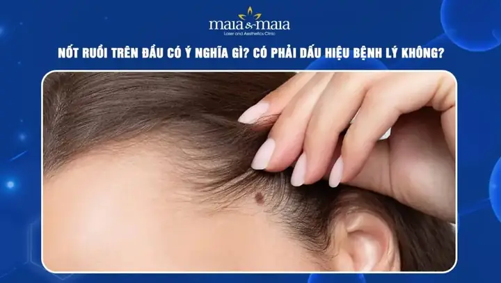 Nốt Ruồi Trên Đầu Trong Tóc: Ý Nghĩa Nhân Tướng Học Và Phong Thủy Toàn Diện Nốt Ruồi Trên Đầu Trong Tóc: Ý Nghĩa Nhân Tướng Học Và Phong Thủy Toàn Diện