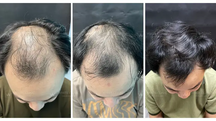 Phác Đồ Điều Trị Rụng Tóc Toàn Diện: Giải Pháp Hiệu Quả Từ Chuyên Gia Phác Đồ Điều Trị Rụng Tóc Toàn Diện: Giải Pháp Hiệu Quả Từ Chuyên Gia