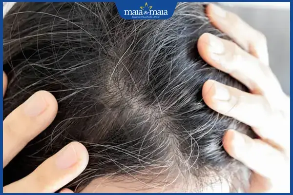 Phòng Ngừa Tóc Bạc Sớm: Nguyên Nhân, Cách Khắc Phục Và Giải Pháp Toàn Diện Cho Bạn