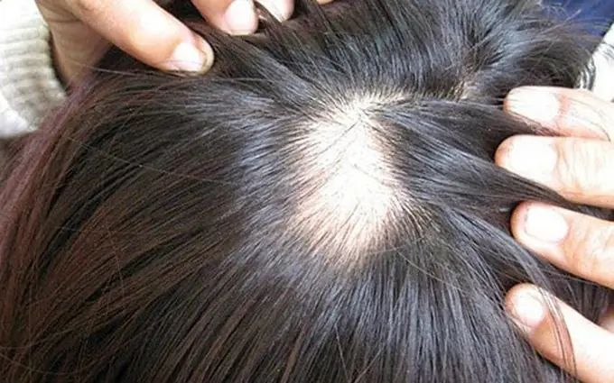 Rụng Tóc Là Biểu Hiện Của Bệnh Gì? Nguyên Nhân & Dấu Hiệu Nhận Biết Sớm Rụng Tóc Là Biểu Hiện Của Bệnh Gì? Nguyên Nhân & Dấu Hiệu Nhận Biết Sớm