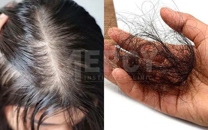 Rụng Tóc Hói Đầu Ở Nữ: Nguyên Nhân, Dấu Hiệu & Cách Cải Thiện Hiệu Quả